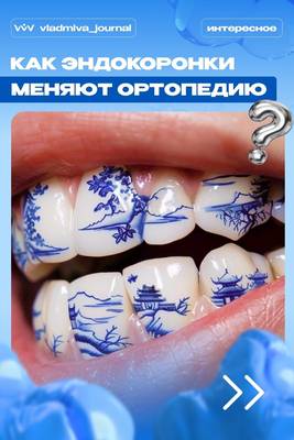 Коронка на корне зуба – эндокоронка как альтернатива штифту.